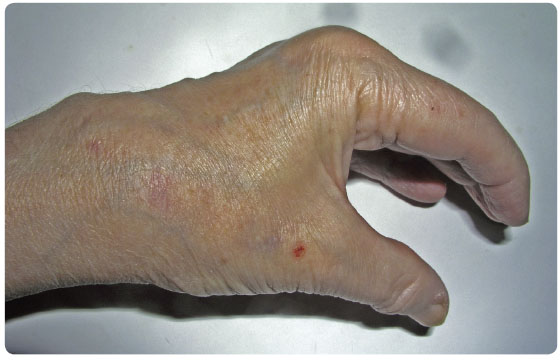 Obr. 5 Deformity v oblasti drobných ručních kloubů ruky.