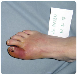 Obr. 2 Osteomyelitida distální falangy palce pravé dolní končetiny.
