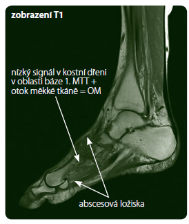  Obr. 3 Vyšetření nohy u pacientky s  osteomyelitidou báze 1. metatarsu a s drénovanými abscesovými ložisky na dorsu levé nohy a pod hlavičkou 1. metatarsu. Zobrazení na magnetické rezonanci.