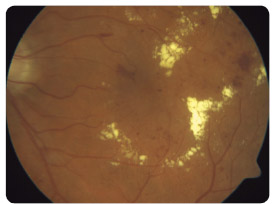 Obr. 1 U diabetika 2. typu (55 let), který byl deset let léčen perorálními antidiabetiky a jehož hladina HbA1c   je 59 mmol/mol, byl náhodně zjištěn makulární edém levého oka s četnými splývavými tvrdými (žlutobělavými) ložisky a hemoragiemi.  Centrální zraková ostrost dle ETDRS optotypu klesla na 0,5.