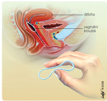 Obr. 1 Umístění vaginálního kroužku ve vaginální dutině; převzato a upraveno z Remedia 2/2008.
