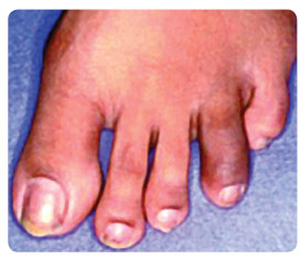  Obr. 1 Daktylitida IV. prstu levé nohy; foto z archivu autorky.