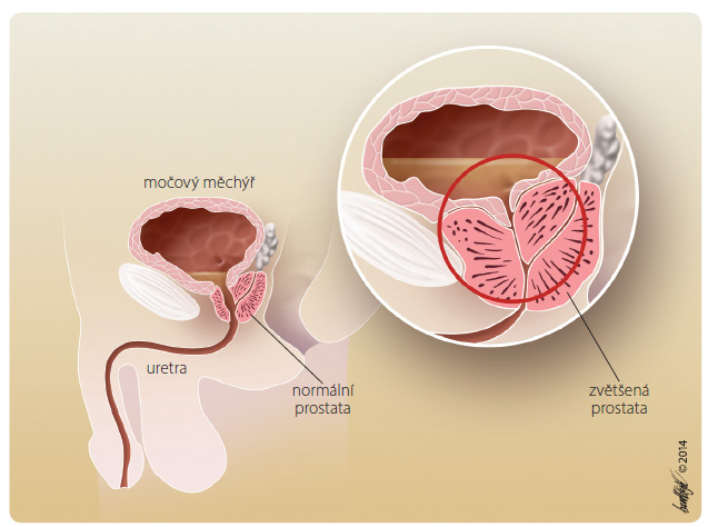 Obr. 1 Schematické znázornění normální a zvětšené prostaty