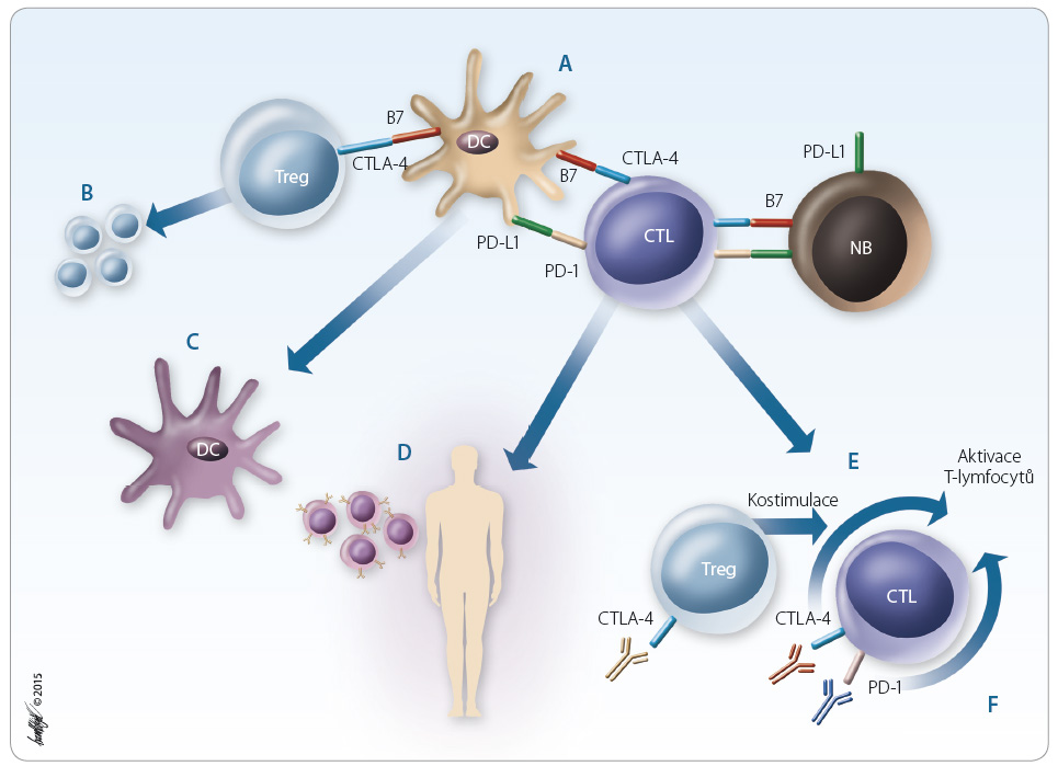Obr. 1 Možnosti využití mechanismů protinádorové imunity k imunoterapii na různých úrovních. A. Schéma interakce buněk prezentujících antigen (DC), cytotoxických lymfocytů a nádorové buňky. Vazbou imunoregulačních molekul na příslušné receptory, např. B7/CTLA-4 nebo PD-1/PD-L1,2, dojde k inhibici T-buněčných funkcí a inhibici kostimulace. B. Eliminace regulačních T-lymfocytů C. Imunoterapie pomocí dendritických buněk D. Adoptivní buněčný přenos pomocí T-lymfocytů E. Blokáda inhibičního receptoru CTLA-4 na povrchu T-lymfocytů pomocí monoklonálních protilátek F. Působení monoklonálních protilátek blokujících imunosupresivní molekulu PD-1 CTL – cytotoxický T-lymfocyt; CTLA-4 – antigen asociovaný s cytotoxickými T-lymfocyty; DC – dendritická buňka; NB – nádorová buňka; PD-1/PD-L1– inhibiční receptor (membránový protein programované buněčné smrti) a jeho ligand; Treg – regulační T-lymfocyt
