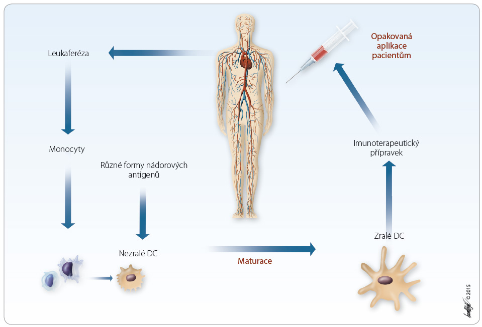 Obr. 2 Obecné schéma protinádorové imunoterapie pomocí aktivní buněčné imunoterapie připravené z dendritických buněk (DC).