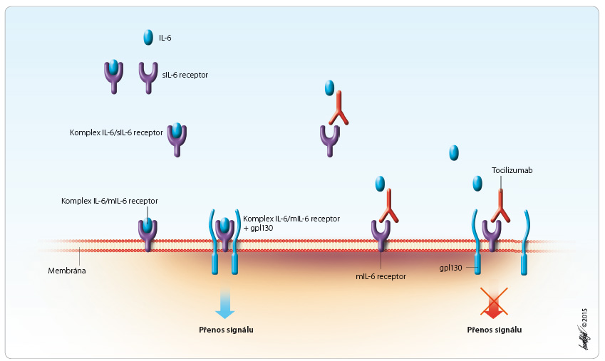 Obr. 1 Přenos signálu prostřednictvím IL-6 a možnost jeho ovlivnění tocilizumabem. mIL-6 receptor – membránový receptor pro IL-6; sIL-6 receptor – solubilní receptor pro IL-6