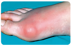 Obr. 1 Akutní dnavá artritida – monoartritida prvního metatarzofalangeálního kloubu, tzv. klasická podagra (z archivu autora).