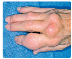 Obr. 2 Chronická tofózní dna – obraz polyartikulární formy dnavé artritidy postihující drobné ruční klouby s dnavými tofy (z archivu autora).