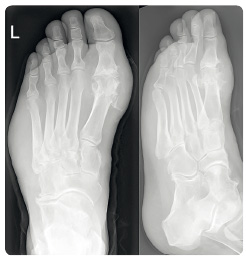 Obr. 3 Chronická tofózní dna – rentgenogram zachycující pokročilé poškození struktury prvního metatarzofalangeálního kloubu levé nohy (z archivu autora).