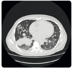 Obr. 1  Mnohočetné  plicní metastázy  na CT obraze před zahájením kombinované léčby dabrafenibem s trametinibem; archiv autora. CT – výpočetní  tomograﬁe