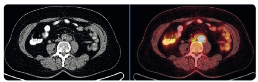 Obr. 4  Patologické uzliny v retroperitoneu před zahájením léčby pembrolizumabem – fúze PET a CT; archiv autora. PET – pozitronová emisní tomograﬁe; CT – výpočetní tomograﬁe