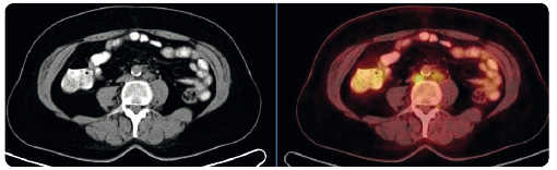 Obr. 5 Parciální remise patologický ch uzlin v retroperitoneu po čtyřech mě sících lé č by pembrolizumabem – fú ze PET a CT; archiv autora. PET – pozitronová emisní tomografi e; CT – výpočetní tomografi e