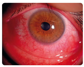 Obr. 11 Syndrom suchého oka (z archivu autorky).