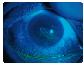 Obr. 12 Syndrom suchého oka, stejné oko po barvení fl uoresceinem v modrém světle (z archivu autorky).