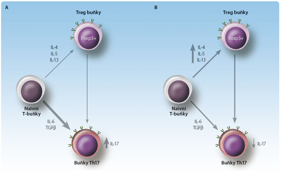 Obr. 1 Imunomodulační aktivity interferonu β; podle [10] – Kasper, et al., 2014. Polarizace T-buněk u neléčených pacientů s roztroušenou sklerózou (A) a účinky IFNβ (B). Polarizace a diferenciace efektorových a regulačních T-buněk je pod vlivem cytokinů. Pacienti s roztroušenou sklerózou mají narůstající počet buněk Th17 vlivem IL-6 a TGFβ, což vede k narůstající sekreci prozánětlivého cytokinu IL-17; IFNβ inhibuje diferenciaci Th17, což vede k poklesu sekrece IL-17. Kromě tohoto efektorového buněčného fenotypu mají pacienti s roztroušenou sklerózou známky dysregulace odpovědi Treg na buňky Foxp3+, které nejsou schopny potlačit aktivitu Th17. Léčba IFNβ vede ke zvýšení počtu buněk Foxp3+ s vyšší produkcí IL-4, IL-5 a IL-13 a přispívá tak k normalizaci sekrece IL-17 buňkami Th17 jako u zdravých jedinců. IFNβ – interferon beta; IL – interleukin; TGFβ – transforming growth factor, transformující růstový faktor beta; Th - T-helper lymphocyte, pomocný T lymfocyt
