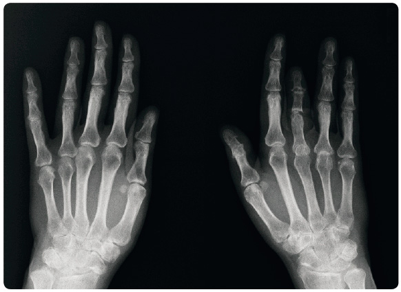 Obr. 1 Rentgenový snímek rukou první pacientky (rok 2011). Na snímku je oboustranně patrné zúžení štěrbiny radiokarpálního kloubu i interkarpálních kloubů. Na pravé ruce je také typické paprsčité postižení s destrukcemi všech tří kloubů prstu s jejich celkovým zkrácením a ankylóza interfalangeálního skloubení pravého palce. Kontrolní snímek rukou z roku 2014 byl bez vývoje. Foto: MUDr. J. Gatterová, Oddělení zobrazovacích metod, Revmatologický ústav, Praha
