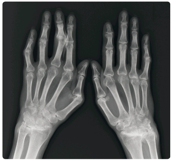 Obr. 2 Rentgenový obraz rukou druhé pacientky ze dne 20. 2. 2015 ukazuje těžké postižení rukou psoriatickou artritidou. Je patrné zúžení štěrbin, destrukce a ankylózy v obou zápěstích, usurace a zúžení štěrbin metakarpofalangeálních skloubení a asymetrické postižení proximálních interfalangeálních kloubů (desaxace 5. prstu vpravo a 3. a 5. prstu vlevo). Foto: MUDr. J. Gatterová, Oddělení zobrazovacích metod, Revmatologický ústav, Praha