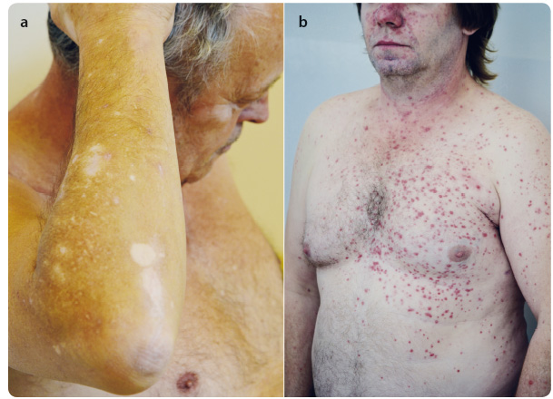 Obr. 3a, b Kožní nežádoucí účinky léčby pembrolizumabem: (a) vitiligo, (b) papulózní exantém s pruritem. Výskyt vitiliga během léčby bývá spojován s lepší účinností léčby anti-PD1.