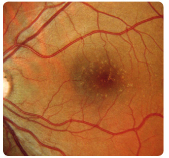 Obr. 1 Ostře ohraničené malé tvrdé drúzy v makule levého oka.