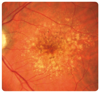 Obr. 2 Neostře ohraničené větší měkké drúzy a přesuny pigmentu v makule levého oka.