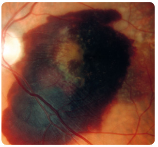 Obr. 4 Krvácení v makule levého oka u vlhké formy VPMD.