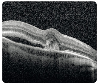 Obr. 6 Chorioideální neovaskulární membrána klasického typu v makule pravého oka zobrazená optickou koherenční tomografií.