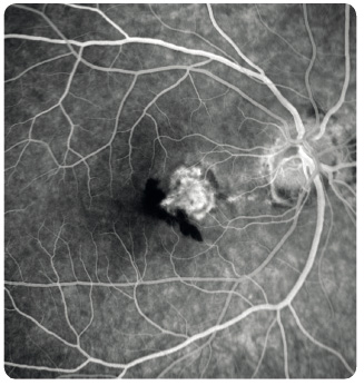 Obr. 8 Chorioideální neovaskulární membrána klasického typu s krvácením v makule pravého oka v časné fázi fl uorescenční angiografie.