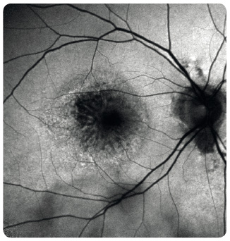 Obr. 10 Autofluorescence fundu pravého oka využívající fluorescenční schopnosti lipofuscinu k odlišení poškozeného pigmentového epitelu a poškozených receptorů sítnice.