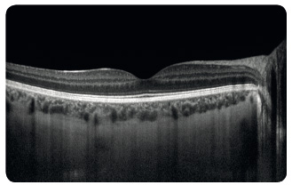 Obr. 11 Optická koherenční tomografi e využívající odrazu světla ke znázornění sítnice. Vodorovný řez centrem pravé makuly, v horní části snímku smyslový epitel sítnice, nejvíce hyperrefl ektivní linie odpovídá retinálnímu pigmentovému epitelu s Bruchovou membránou, dole cévnatka.