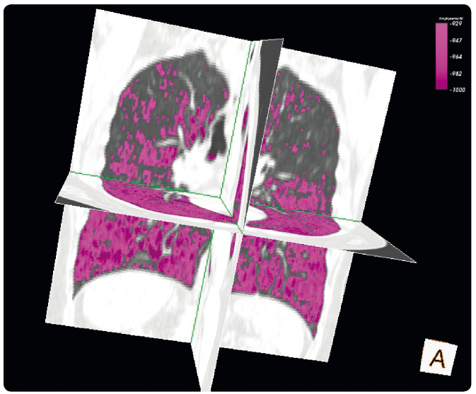Obr. 1 Grafické znázornění hustoty plicní tkáně u pacienta s CHOPN na podkladě deficitu alfa-1 antitrypsinu (z archivu autora). Růžová barva znázorňuje plicní tkáň s hustotou nižší než –950 HU, která je považována za ekvivalent emfyzému, u této nemoci typicky s bazální predilekcí. CHOPN – chronická obstrukční plicní nemoc