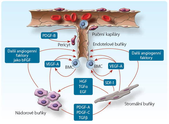 Obr. 2 Nádorová angiogeneze – novotvorba cév; podle [3,4] – Klener, 2002; Ferrara, Kerbel, 2005. Angiogenní faktory uvolňované zejména z nádorových buněk stimulují angiogenezi. Kromě přímých angiogenních faktorů (VEGF, bFGF a HGF) se uplatňují i nepřímé angiogenní faktory, které způsobují zvýšený výdej faktorů přímých (TGFα, EGF, PDGF a jiné). VEGF jako nejvýznamnější faktor angiogeneze je růstovým faktorem pro endotelie, váže se na jejich receptory a spouští transdukční kaskádu, jejímž výsledkem je zvýšená proliferace a permeabilita cév a usnadněná migrace buněk. bFGF – basic fibroblast growth factor 2, bazický fibroblastový růstový faktor 2; BMC – bone marrow cell, krvetvorné kmenové buňky; EGF – endothelial growth factor, endoteliální růstový faktor; HGF – hepatocyte growth factor, hepatocytární růstový faktor; PDGF – platelet‑derived growth factor, destičkový růstový faktor; SDF‑1 – stromal cell‑derived factor 1, stromální buněčný růstový faktor; TGFα (β) – transforming growth factor alfa (beta), transformující růstový faktor alfa (beta); VEGF – vascular endothelial growth factor, vaskulární endoteliální růstový faktor