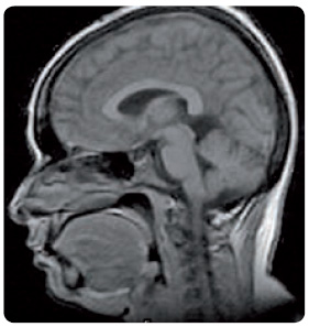 Obr. 2 Benigní intrakraniální hypertenze při zobrazení magnetickou rezonancí (foto: archiv autora).