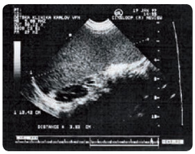 Obr. 5 Masivní splenomegalie – pacient s Gaucherovou nemocí před zahájením léčby; ultrasonografické vyšetření (foto KDDL VFN v Praze, použito se svolením autorky).