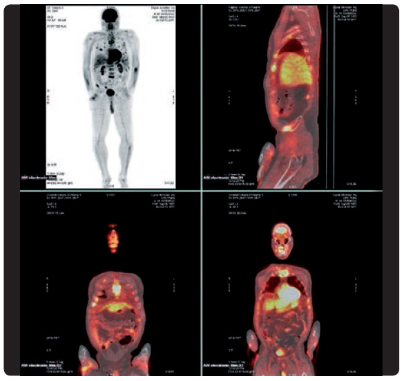 Obr. 6 Plazmocytom u pacienta s Gaucherovou nemocí; vyšetření pozitronovou emisní tomografií (foto KDDL VFN v Praze, použito se svolením autorky).