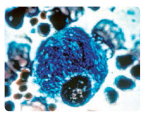 Obr. 10 Cytologický obraz lysosomálního střádání v makrofázích v nátěru kostní dřeně – Gaucherova buňka s charakteristickou cytoplazmou vzhledu „zmačkaného papíru“ s excentricky umístěným jádrem, PAS (Periodic Acid Schiff) barvení; podle [10] – Gaucher disease and Cerezyme® monograph, 2005.