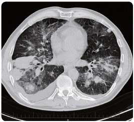 Obr. 2 CT hrudníku a horní části břicha před zahájením léčby.
