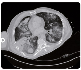 Obr. 3 Na základě vyšetření CT diagnostikován primární plicní adenokarcinom acinárně mikropapilárního typu.