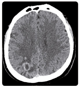 Obr. 6 Průkaz mnohočetných metastáz do mozku na CT po 18 měsících léčby.