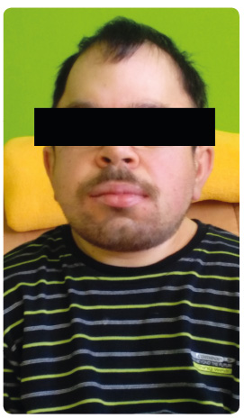 Obr. 1 Klinické projevy mukopolysacharidózy typu II u 32letého pacienta se středně závažnou formou onemocnění. Charakteristické hrubé rysy obličeje.