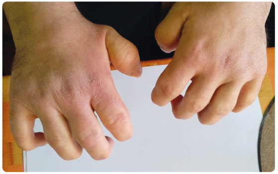 Obr. 2 Klinické projevy mukopolysacharidózy typu II u 32letého pacienta se středně závažnou formou onemocnění. Typické drápovité ruce s kontrakturami drobných kloubů a se širokými krátkými prsty.