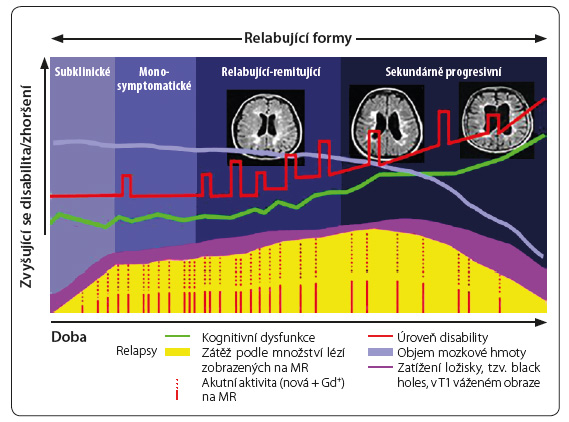 Obr. 2 Klinický průběh roztroušené sklerózy; podle [37–39] – Noseworthy, et al., 2000; Weinshenker, et al., 1989; Trapp, et al., 1999. Gd – gadolinium; MR – magnetická rezonance