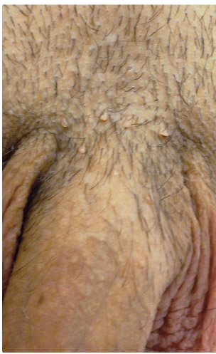 OBR. 1 pacient s akuminátními kondylomaty kořene penisu a podbřišku před léčbou lokálním imiquimodem (z archivu autora).
