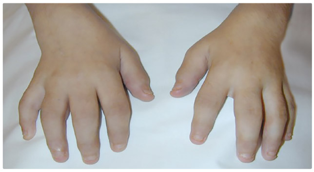 OBR. 2 Artritida drobných ručních kloubů a zápěstí u pětiletého dítěte (z archivu autorky).