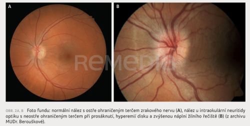 Oční příznaky v ambulanci pro roztroušenou sklerózu