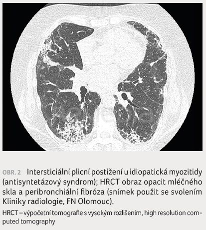 Rozšiřující se možnosti léčby intersticiálního plicního postižení u systémových onemocnění pojiva