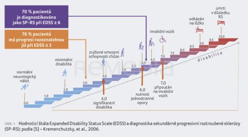 Siponimod v léčbě sekundárně progresivní roztroušené sklerózy – příběh z praxe