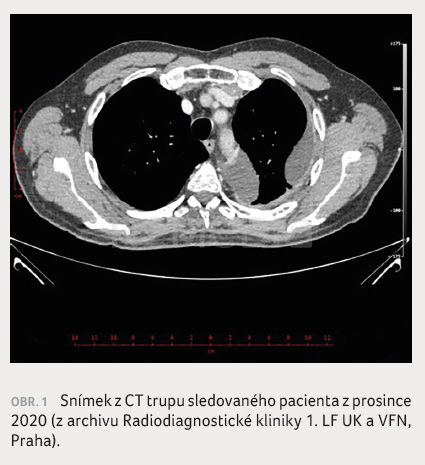 Osimertinib v terapii pokročilého neskvamózního nemalobuněčného plicního karcinomu