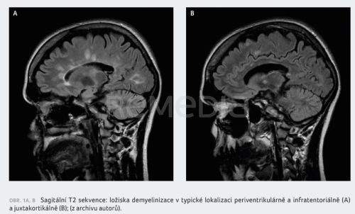 Siponimod v léčbě roztroušené sklerózy – kazuistika