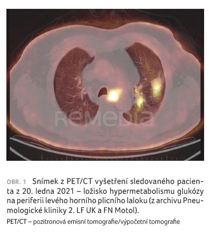 Durvalumab v léčbě lokálně pokročilého nemalobuněčného karcinomu plic