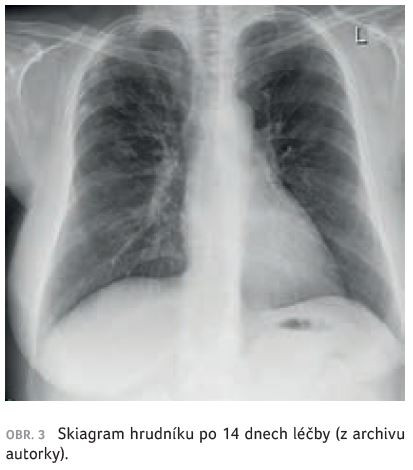 OBR. 3 Skiagram hrudníku po 14 dnech léčby (z archivu autorky).